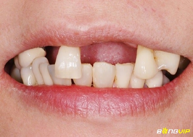 Giấc mơ thấy rụng nhiều răng cùng lúc thể hiện cho tâm lý bất an trong bạn