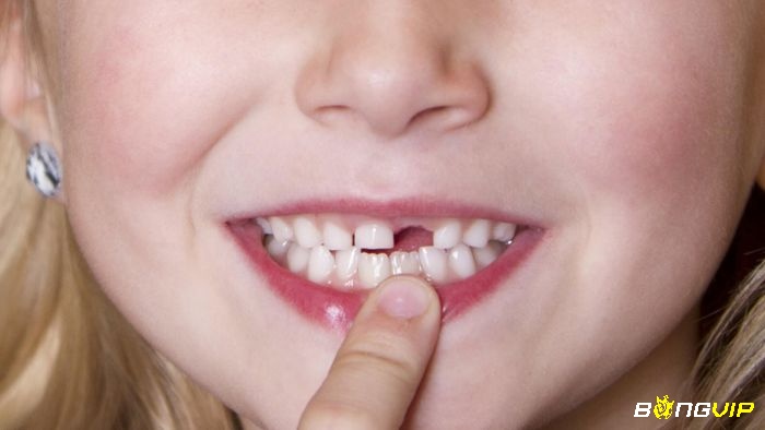 Giấc mơ thấy rụng răng cửa hàm trên thể hiện cho sự lo lắng của bạn trước những nhận định của người khác về mình